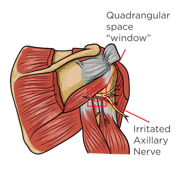 Neck and Shoulder Pain – Clayton Chiropractic Center