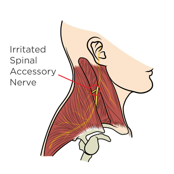 Neck and Shoulder Pain – Clayton Chiropractic Center